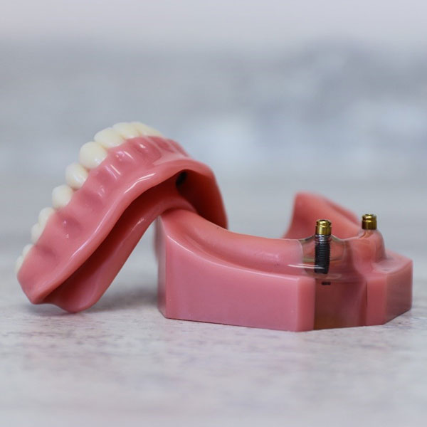 implant dentures