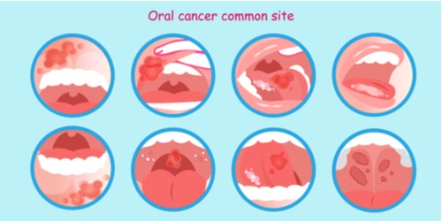 drawing of mouth cancer