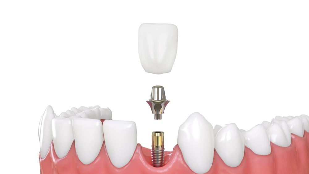 dental implant animation