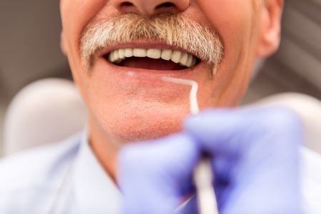 man smiling with visible suction dentures