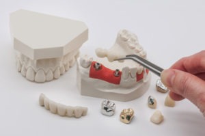 dental implants shown on model teeth