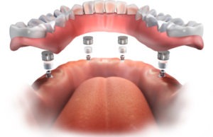 implant dentures shown with dental implant screws in jaw bone