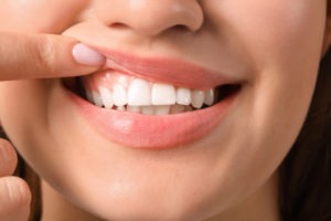woman holding up her upper lip to showcase her gums