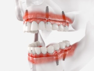 implant dentures shown supporting the jaw bone